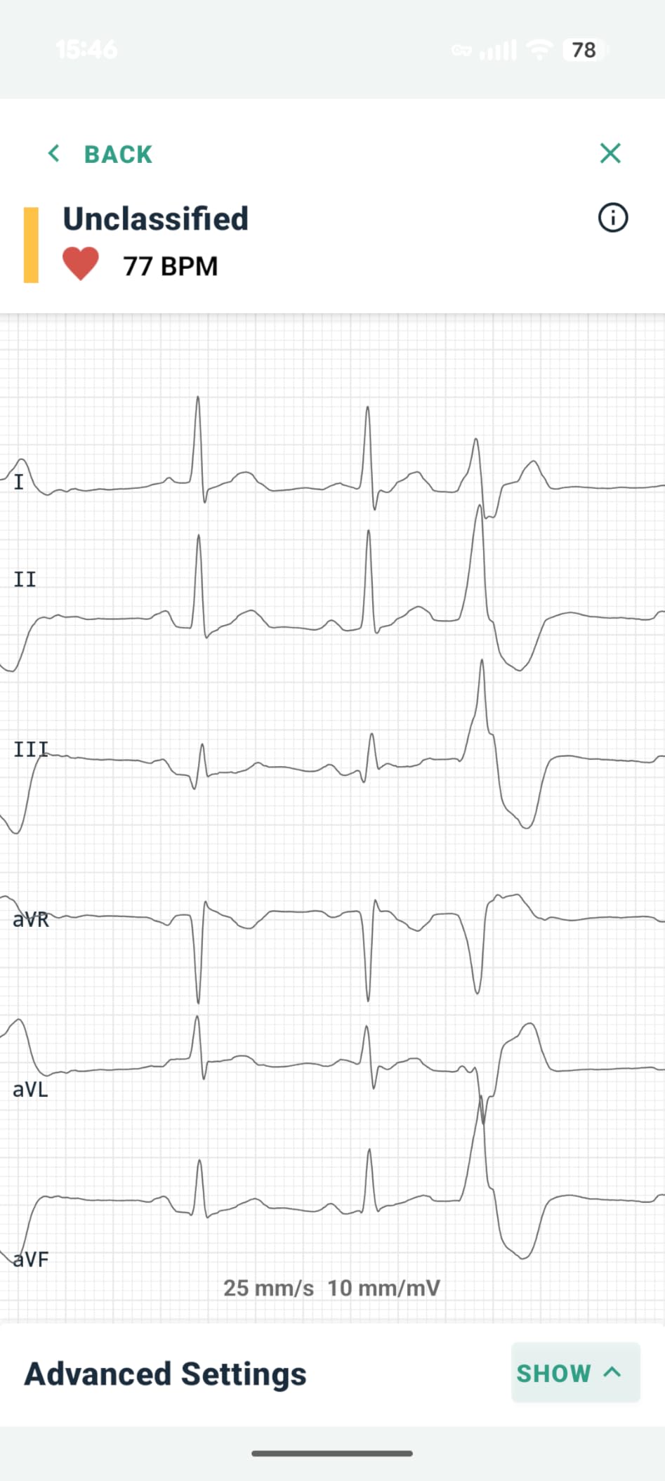 KardiaMobile 6-Lead Personal EKG Monitor – Six Views of The Heart – Detects AFib and Irregular Arrhythmias – Instant Results in 30 Seconds – Works with Most Smartphones - FSA/HSA Eligible customer photo 1