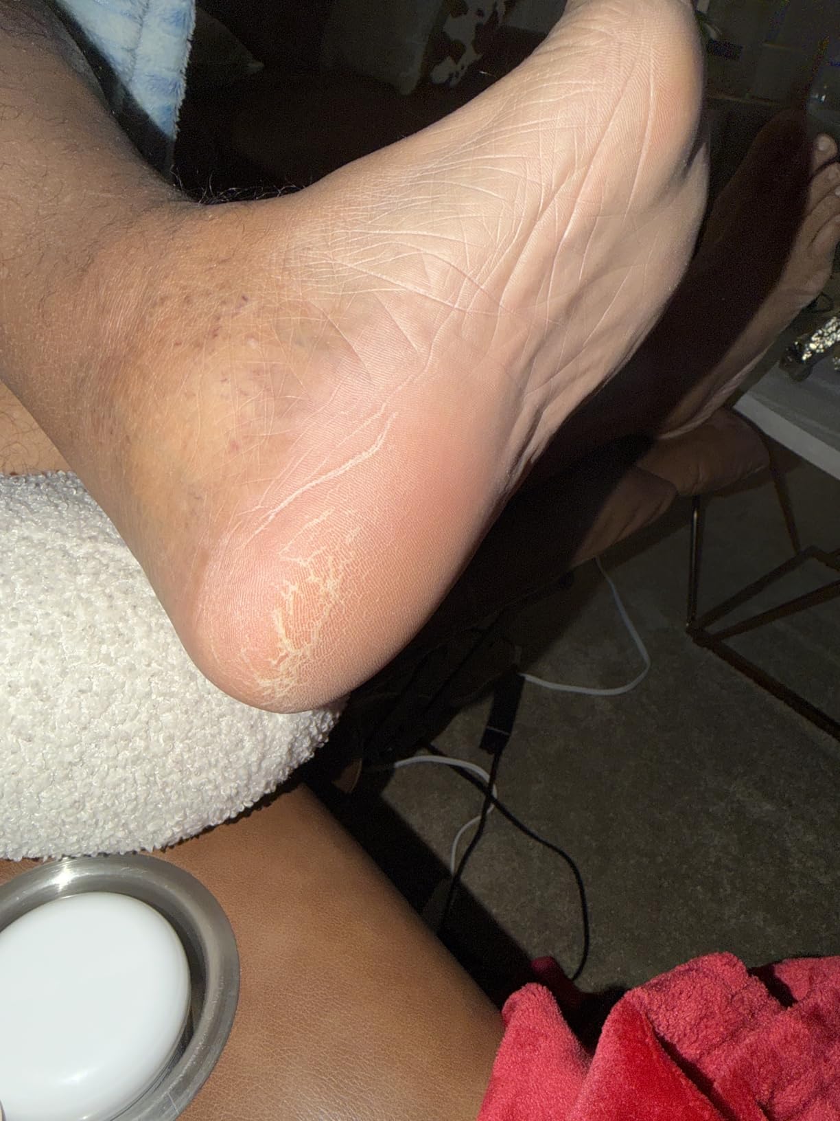 Ebanel Urea Cream 40% plus Salicylic Acid 2% for Dry Cracked Feet Skin customer photo 2