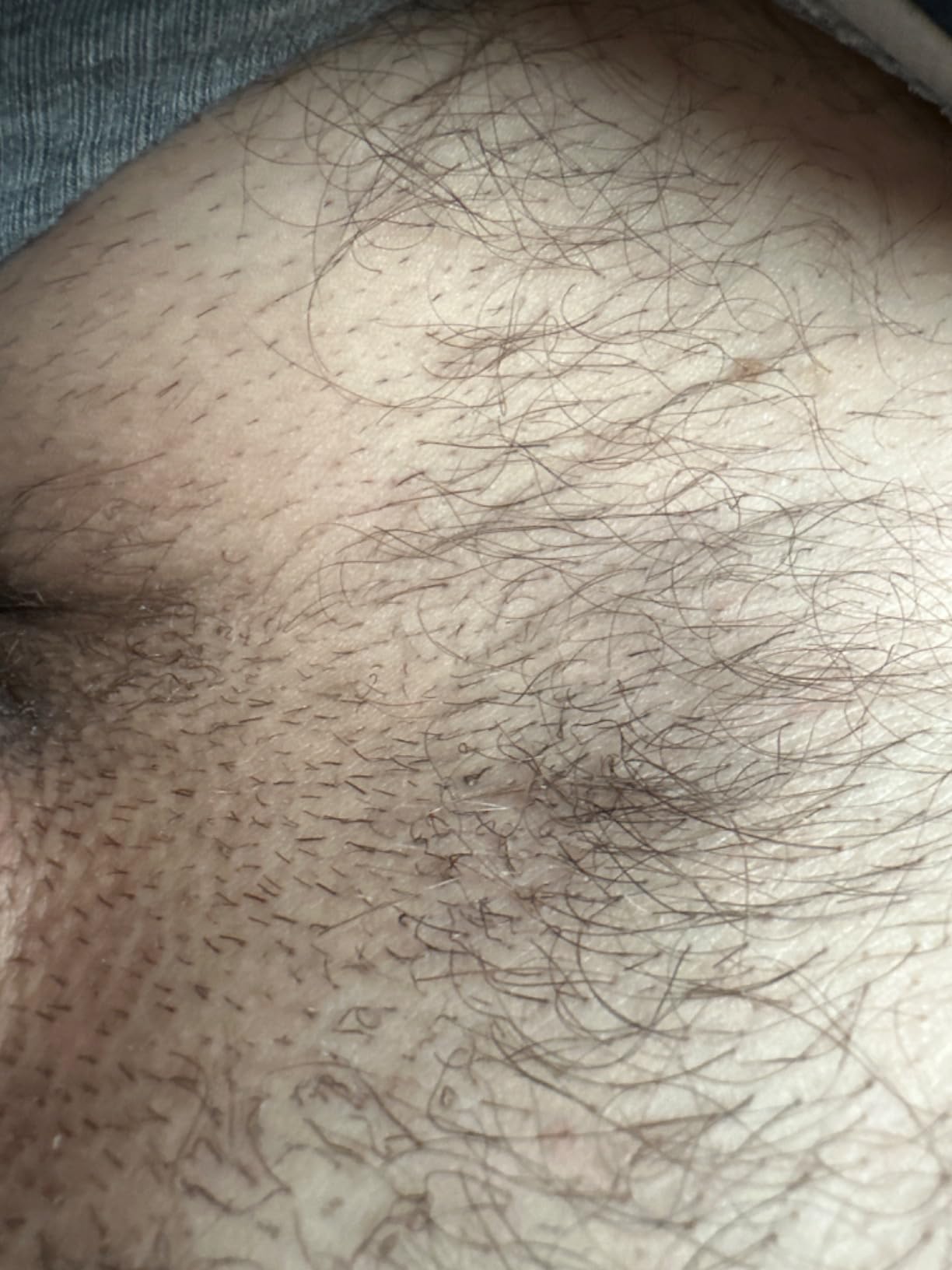 Braun Smart IPL, Skin i·Expert Pro 7, VOGUE's Best Hair Removal Device, IPL Hair Removal for Women and Men, Permanent Laser Hair Reduction At-Home, World's 1st Smart App, 3 Heads, IPL7243 customer photo 1