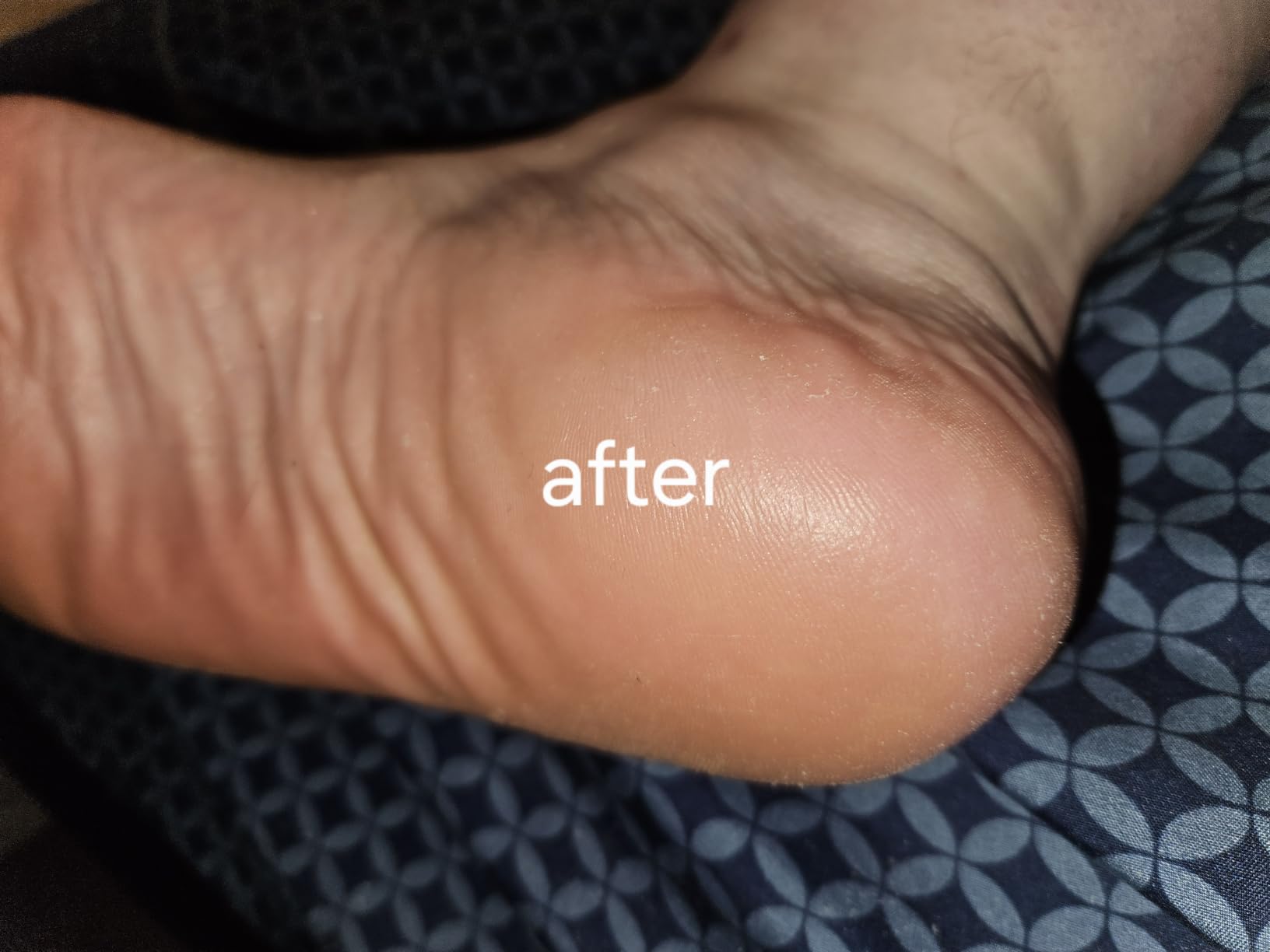 Lee Beauty 6oz Professional Gel Callus Remover for Feet customer photo 1